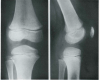Človeško koleno